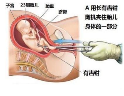 7個(gè)月無痛引產(chǎn)詳細(xì)過程,關(guān)于七個(gè)月無痛引產(chǎn)的全過程詳解